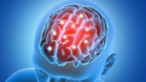 Strategi Pencegahan Penyakit Meningitis Yang Perlu Perhatian Medis Darurat