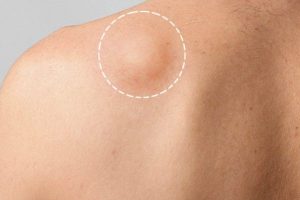 Strategi Pencegahan Penyakit Lipoma Yang Terdiri Dari Sel Lemak