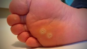 Mengenal Penyakit Mata Ikan Dan Strategi Pencegahannya